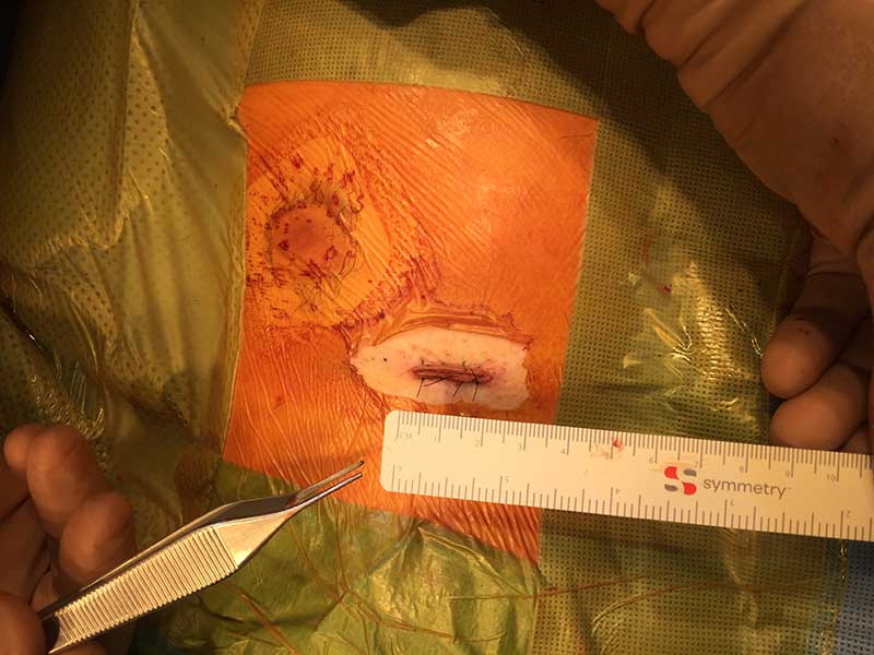 Sutured 20mm incision after rib cartilage harvest