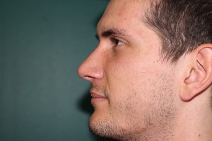 Rhinoplasty case - Post-operative