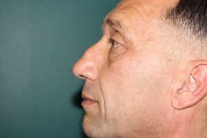 Rhinoplasty case - Preoperative